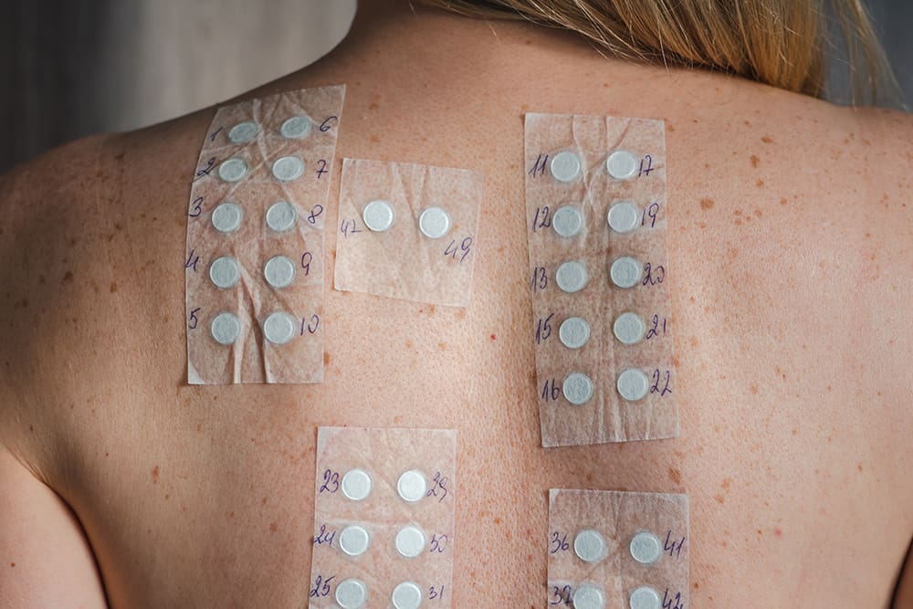 Allergy Testing in Madison, AL Allergy Testing in Madison, AL