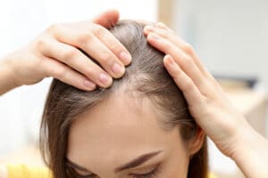 Hormones and Hair Loss: Can HRT Help Restore Thinning Hair?